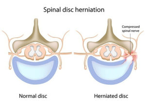 Spinal Disc Herniation